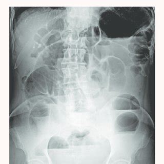 Phytobezoar from the terminal ileum. | Download Scientific Diagram