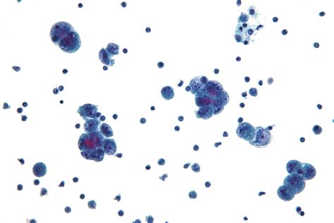 Primary Peritoneal Carcinoma | Diagnosis & Prognosis