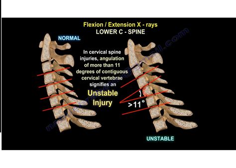 Cervical Spine Instability — OrthopaedicPrinciples.com