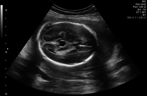 Prenatal Diagnosis of a Cavum Veli Interpositi - Blasi - 2009 - Journal of Ultrasound in ...