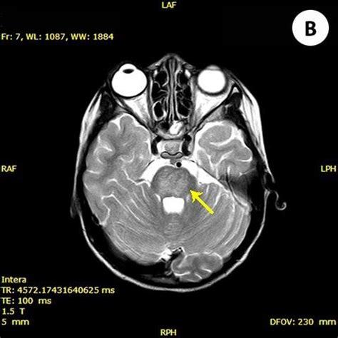 Axial T1-weighted image showing pontine lesion with low signal... | Download Scientific Diagram