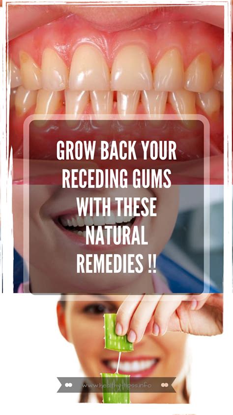 GROW BACK YOUR RECEDING GUMS WITH THESE NATURAL REMEDIES !! | Receding gums, Gum care, Natural ...