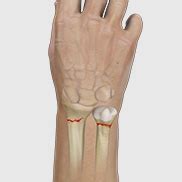 Wrist Open Reduction & Internal Fixation | Advanced Orthopaedics ...