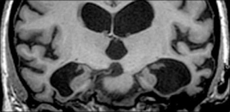 Dementia – MRI is the first step in diagnosis • healthcare-in-europe.com