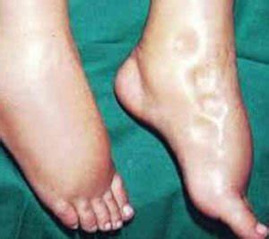 What is Anasarca - Definition, Causes, Pictures and Treatment