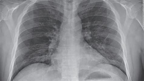 New report on first US case of novel coronavirus details mild symptoms ...