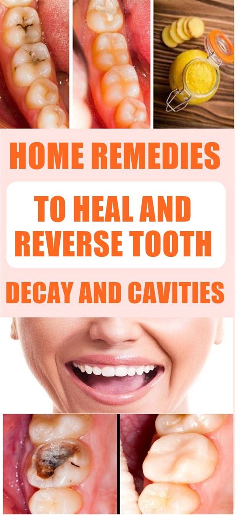 How To Fix A Rotten Tooth At Home - Vanessa Fernandez Hochzeitstorte