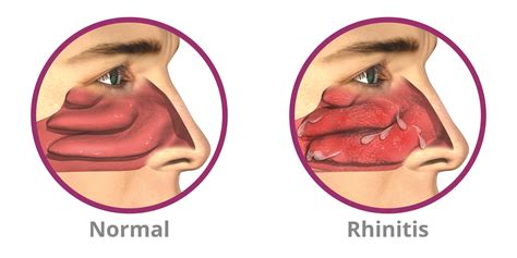 Chronic Rhinitis Treatment | RhinAer