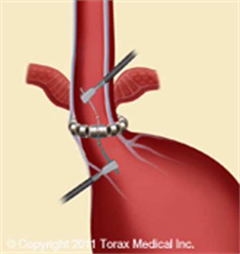 LINX Norwalk | Reflux Management System New London