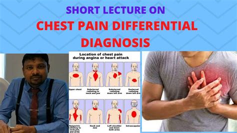 What Is Chest Pain On The Left Side at Lourdes Strickler blog