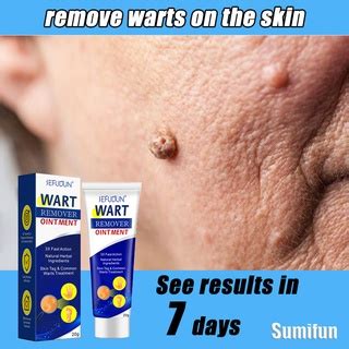 Warts Remover Original Cream Warts Magic Remover Ointment Wart Removal ...