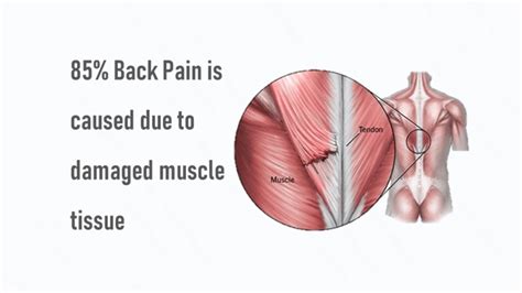 Lower Back Muscle Strain Treatment, Causes & Diagnosis | QI Spine