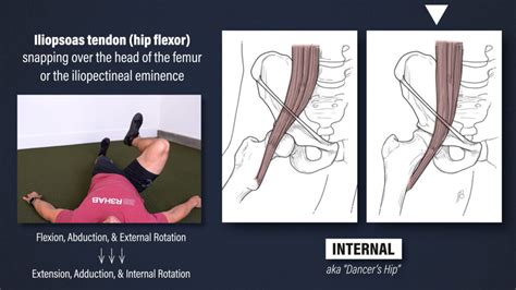 Snapping Hip Syndrome - E3 Rehab