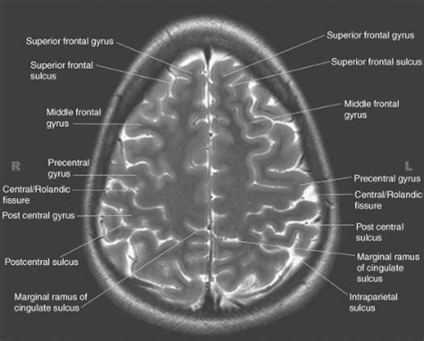 Introduction to Brain Imaging | Radiology Key