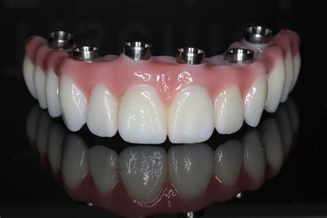 Prettau Zirconia Implant Bridge | Teeth Tomorrow Dental Lab