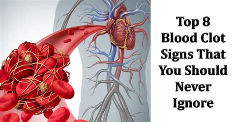 Top 8 Blood Clot Signs That Trigger Warning - WhatToLaugh