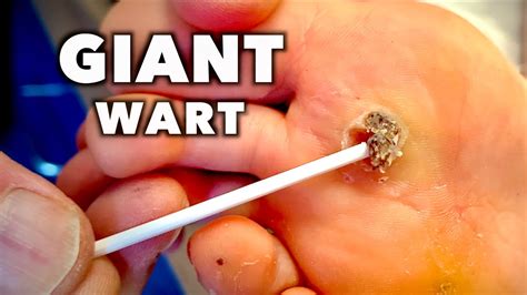 Plantar Wart Root Removal | Bruin Blog