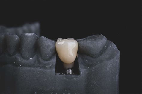 Titanium Biocompatibility for Medicine Applications Like Dental Implant Due to Its High ...