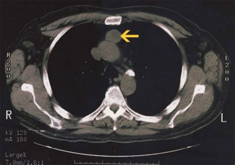 Mediastinal Diseases and Masses / Thymoma | Department of Cardiothoracic Surgery | Stanford Medicine