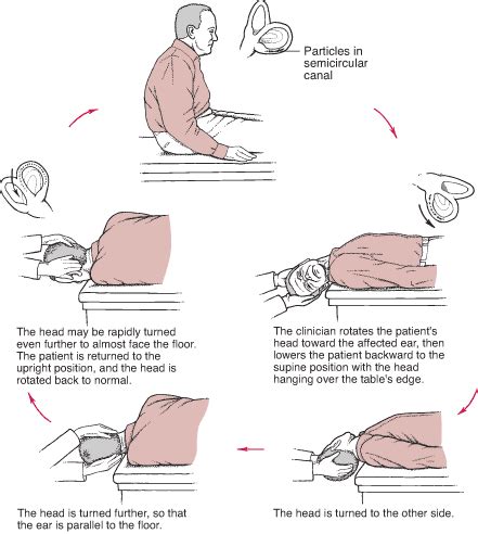 Vertigo - symptoms, causes, diagnosis, Vertigo treatment