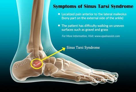 Symptoms of Sinus Tarsi Syndrome | Sinusitis, Treatment recovery, Symptoms