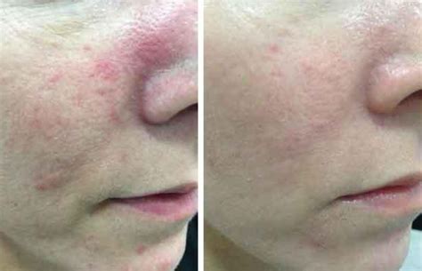 ipl for rosacea at home - pricesbradleysmokers