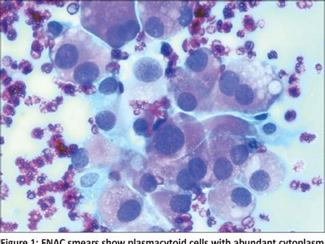 Figure 1 from FNAC diagnosis of medullary carcinoma thyroid: A report of three cases with review ...