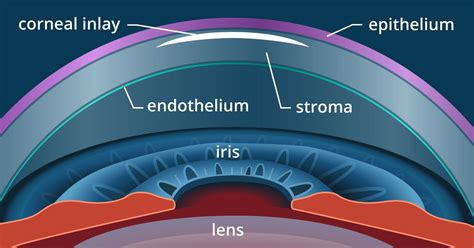 Presbyopia Surgery and Monovision LASIK