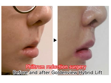 Goldenview Plastic surgery: Lip lift - philtrum surgery (philtrum ...