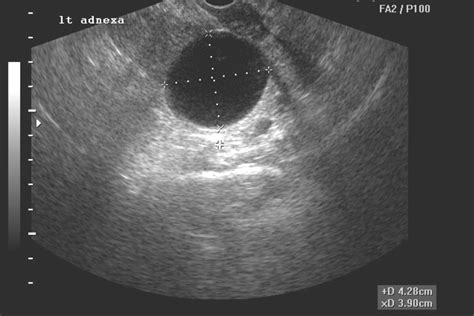 √ Ovarian Cancer Ultrasound / Ovarian Cancer And Pregnancy Intechopen : Ovarian cancer is the ...