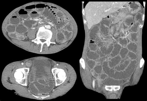 Femoral Ring Hernia