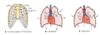 Flail Chest: Symptoms & Treatment | Study.com