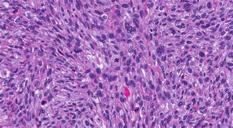 Myxofibrosarcoma | Atlas of Pathology