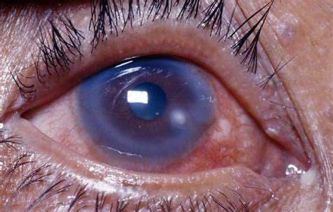 What is a Corneal Ulcer >Symptoms,Treatments | Top Eye Doctor Near Me