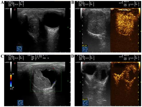 (A) Two-dimensional ultrasound image of pleomorphic adenoma of lacrimal ...