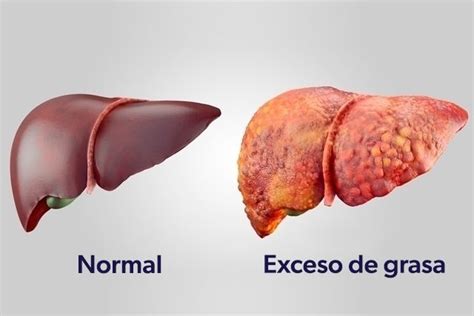 8 principales síntomas de esteatosis hepática (con test online) - Tua Saúde