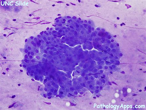 warthin tumor salivary gland cytology