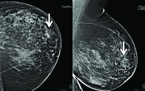 A 66-year-old female with abnormal screening mammogram showing a mixed... | Download Scientific ...