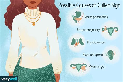 Cullen Sign: Symptoms, Causes, Diagnosis, and Treatment