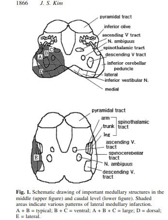 Lateral Pontine Syndrome Mri