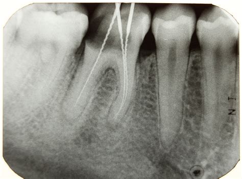 File:Dental X-ray 2012 PD 04.JPG