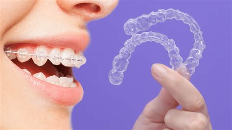 Invisalign vs. Braces: Which is for you?- Ricci Orthodontics