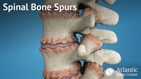 Spinal Bone Spurs - YouTube