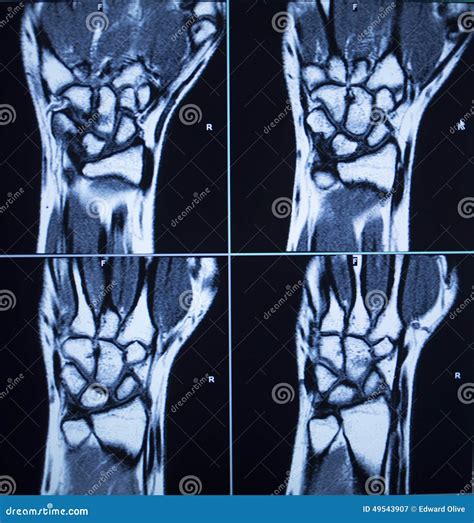 MRI Scan Test Results Wrist Hand Injury Stock Image - Image of medical, damaged: 49543907