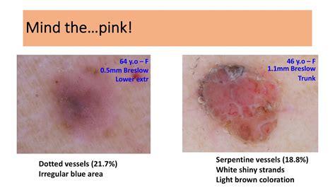 Nodular Melanoma Pictures Symptoms Prognosis