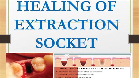 HEALING OF EXTRACTION SOCKET I Oral Pathology I Dental Guide I Dr ...