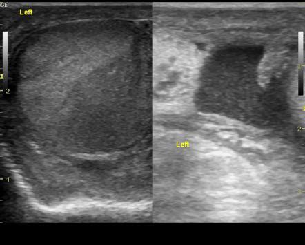 Isolated orchitis | Image | Radiopaedia.org