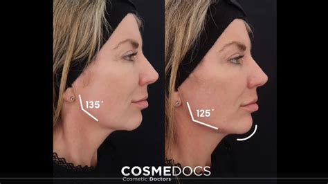 Jawline Fillers Before After Results At Skinly