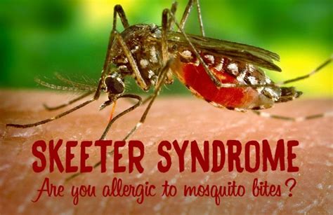 Skeeter Syndrome: Symptoms & Best Remedies For Mosquito Bites