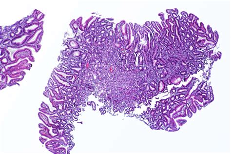 Chronic bile reflux symptoms | Gastrointestinal Disorders articles ...